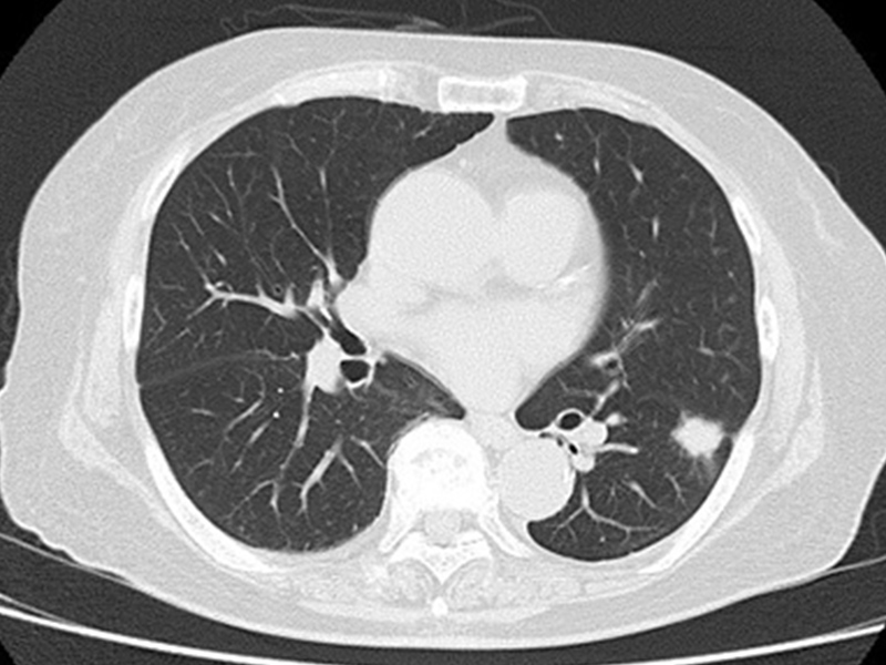 画像：肺がん