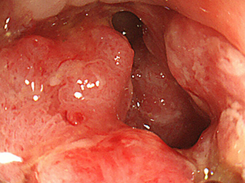 画像：大腸がんの症状